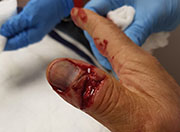 Laceracion en dedo pulgar